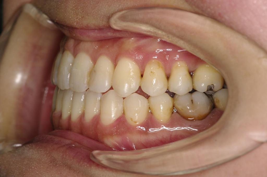顎、顔の歪みの矯正治療後口内写真NO.383