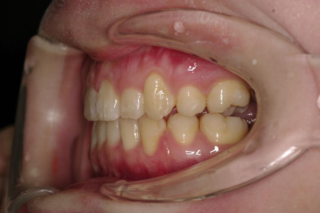顎、顔の歪みの矯正治療後口内写真NO.387