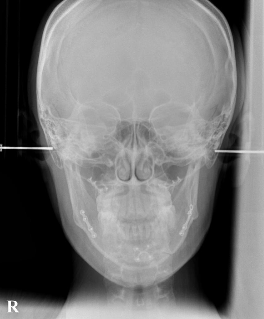 顎、顔の歪みの矯正治療後口内写真NO.390