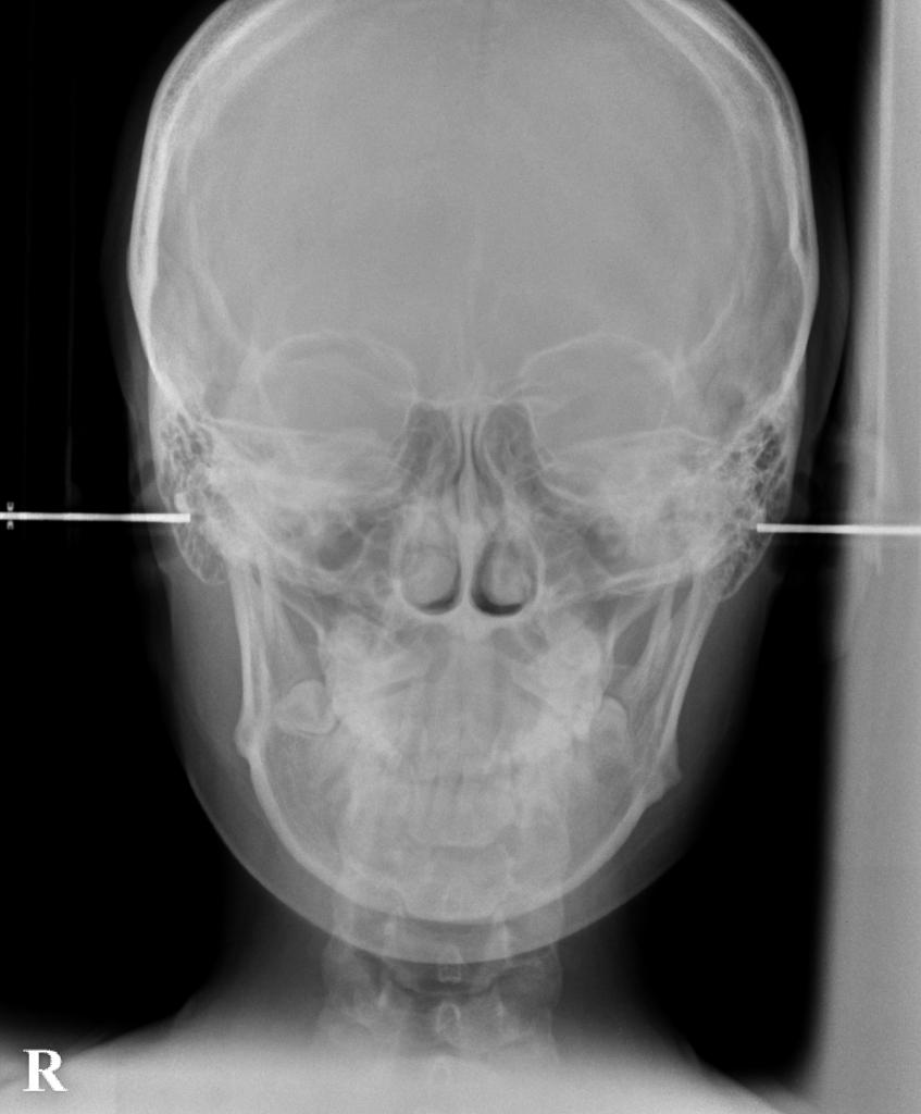 顎、顔の歪みの矯正治療前口内写真NO.395