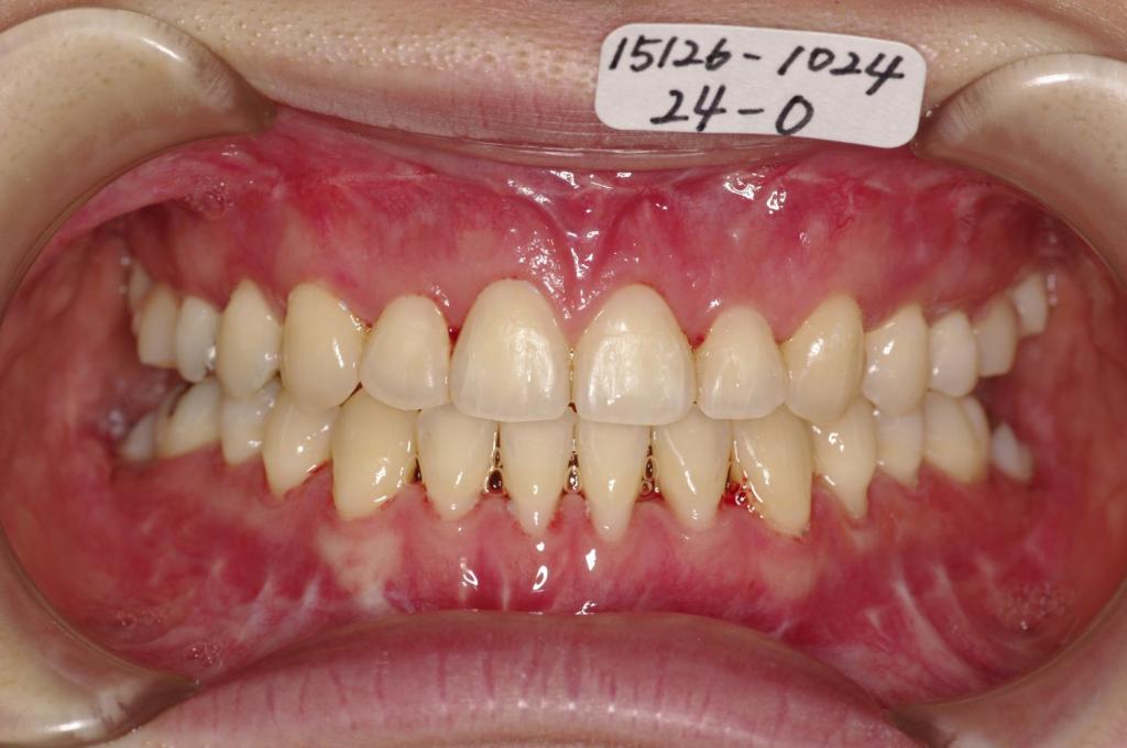 顎、顔の歪みの矯正治療後口内写真NO.396
