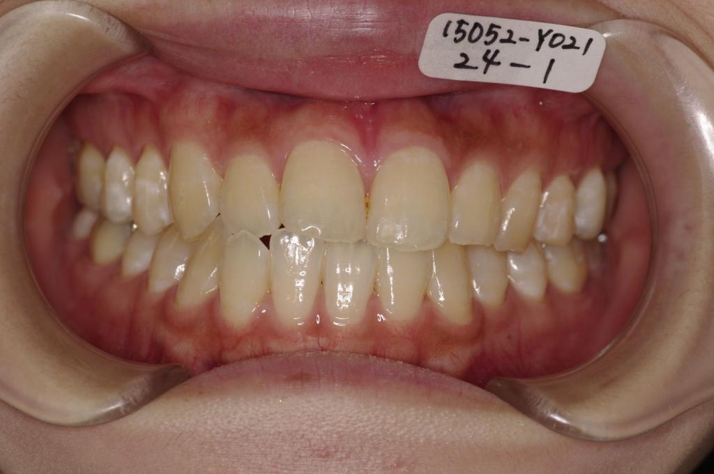 顎、顔の歪みの矯正治療前口内写真NO.407