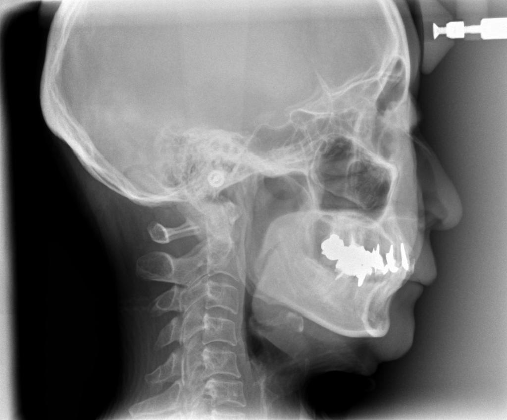 顎、顔の歪みの矯正治療前口内写真NO.408
