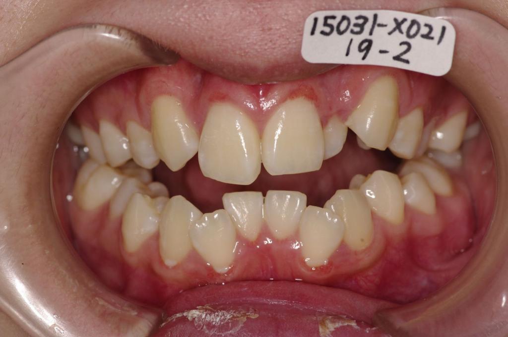 顎、顔の歪みの矯正治療前口内写真NO.415