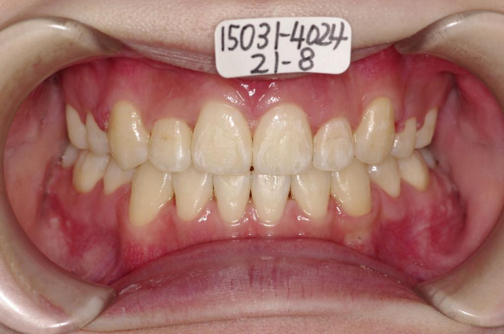 顎、顔の歪みの矯正治療後口内写真NO.415