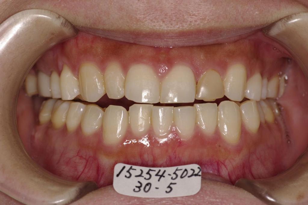 顎、顔の歪みの矯正治療前口内写真NO.426
