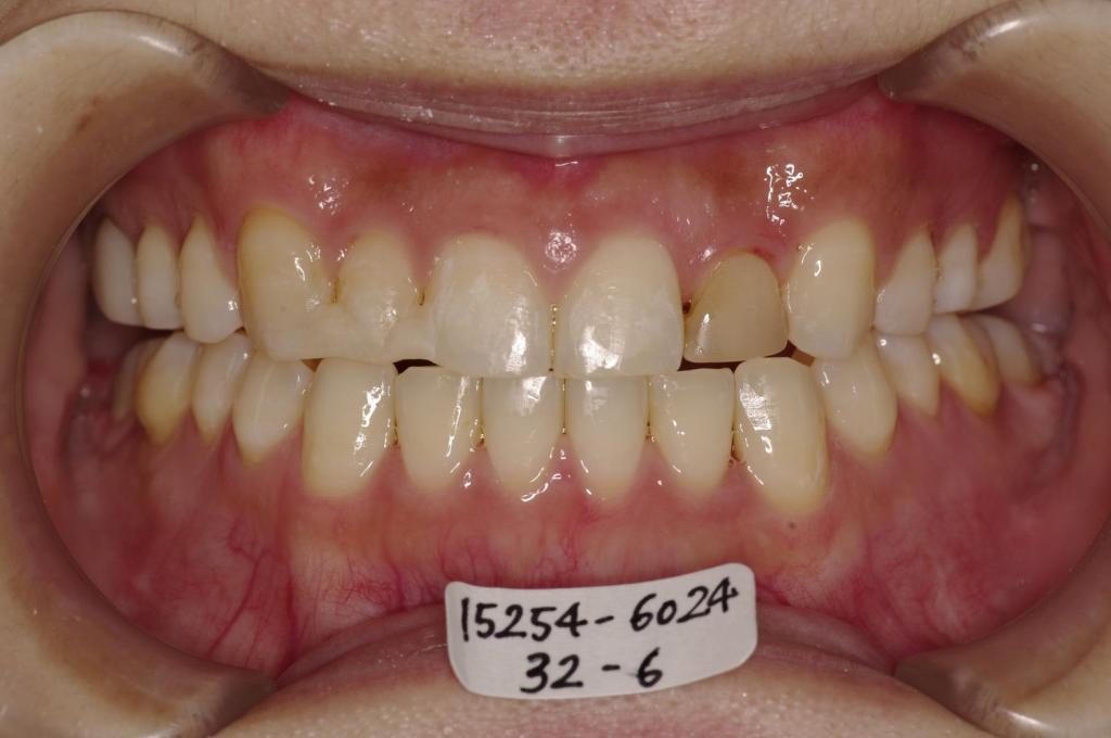 顎、顔の歪みの矯正治療後口内写真NO.426