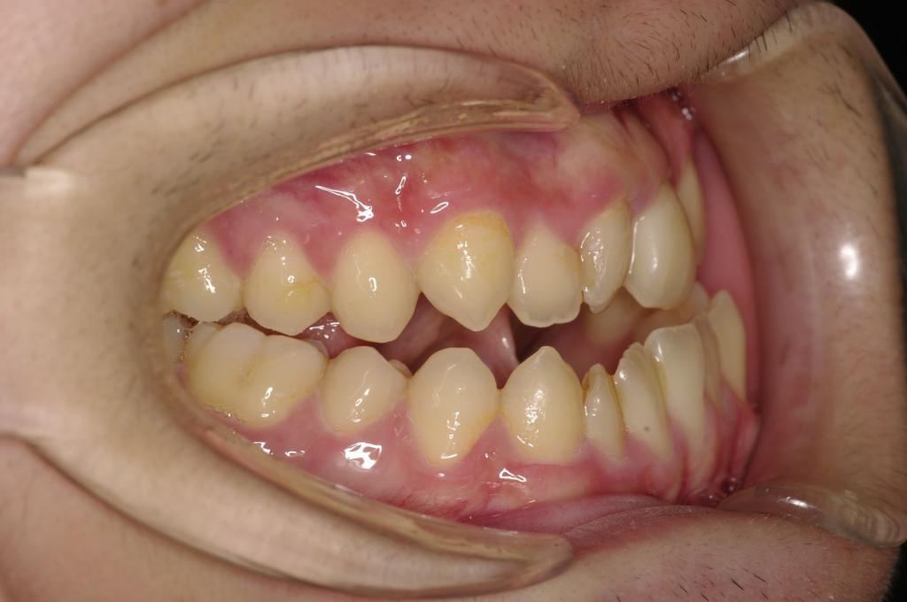 顎、顔の歪みの矯正治療前口内写真NO.497