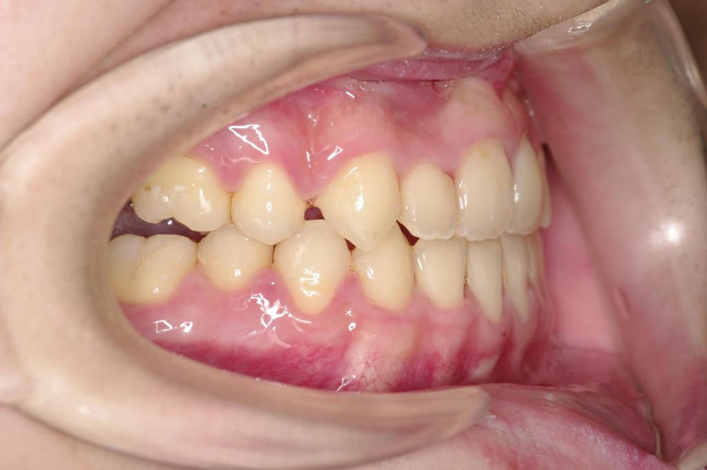 顎、顔の歪みの矯正治療後口内写真NO.497