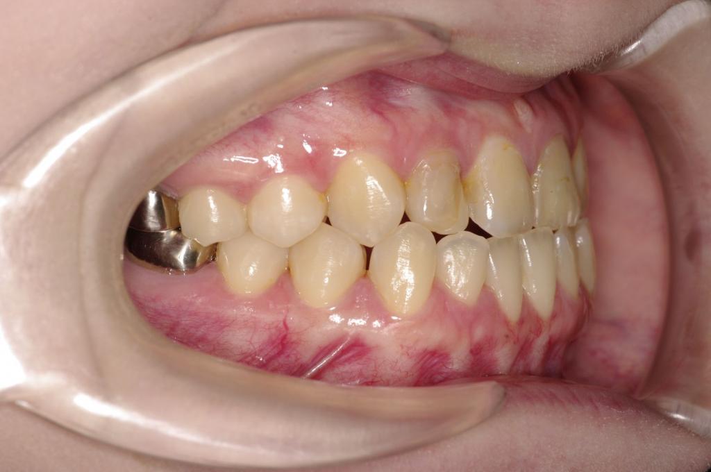 顎、顔の歪みの矯正治療前口内写真NO.498