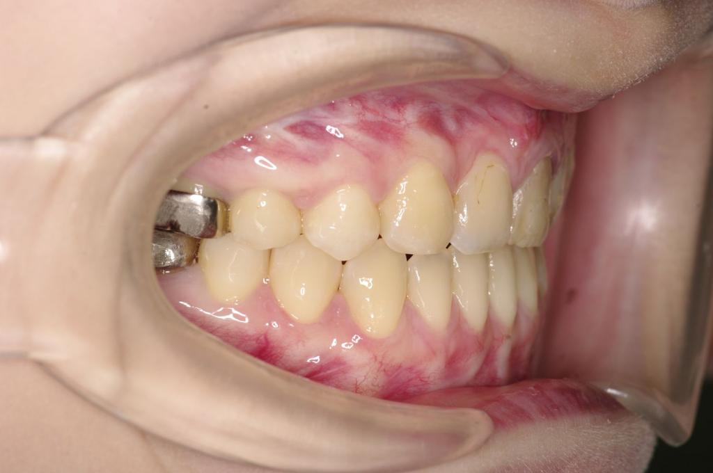 顎、顔の歪みの矯正治療後口内写真NO.498