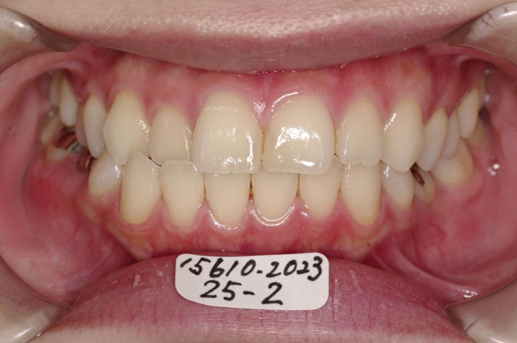 顎、顔の歪みの矯正治療前口内写真NO.499