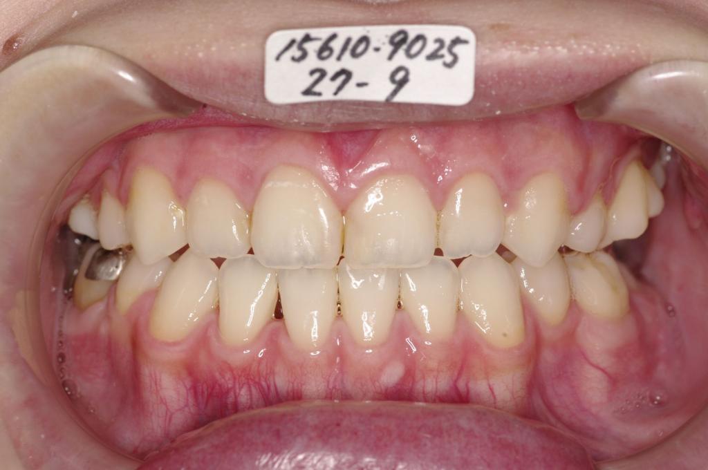 顎、顔の歪みの矯正治療後口内写真NO.499