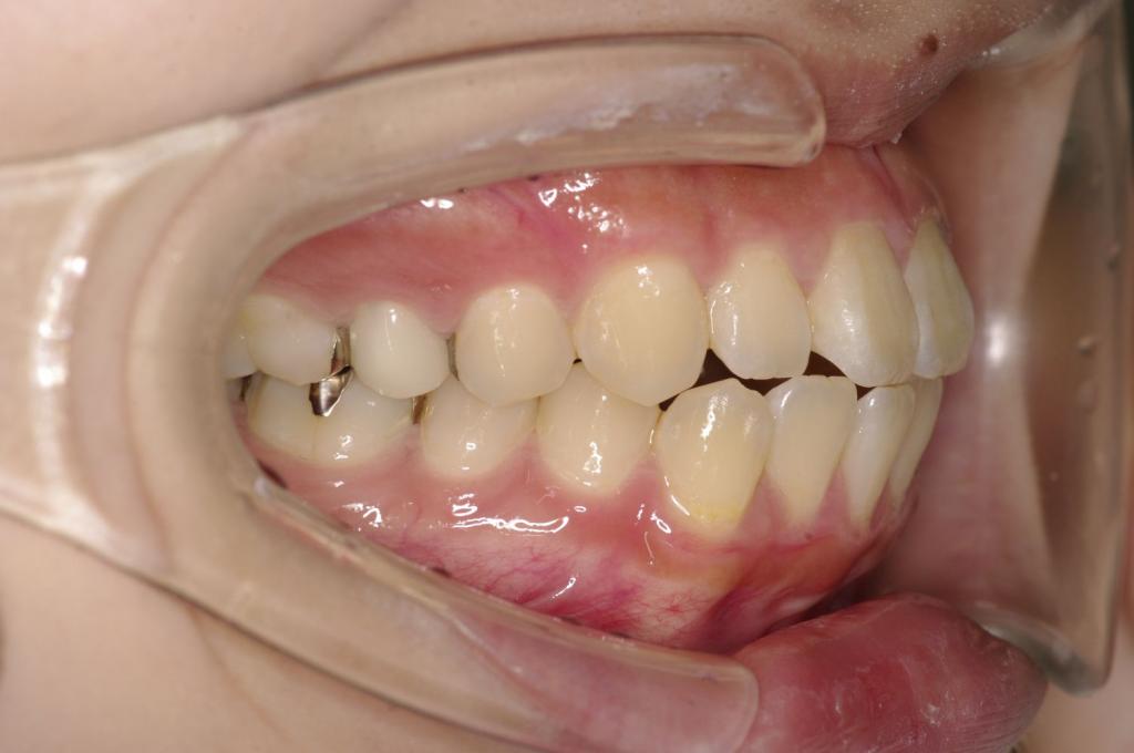 顎、顔の歪みの矯正治療前口内写真NO.500