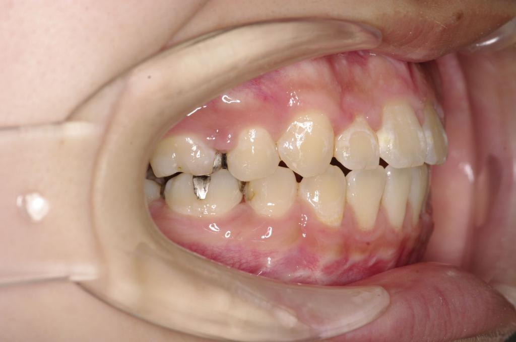 顎、顔の歪みの矯正治療後口内写真NO.500