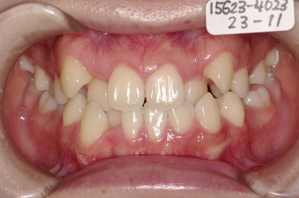 顎、顔の歪みの矯正治療前口内写真NO.501