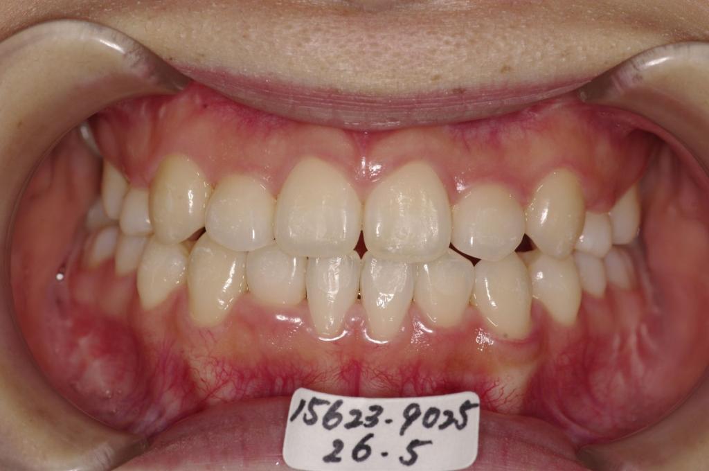 顎、顔の歪みの矯正治療後口内写真NO.501