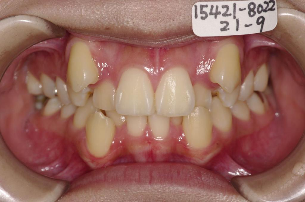 顎、顔の歪みの矯正治療前口内写真NO.502