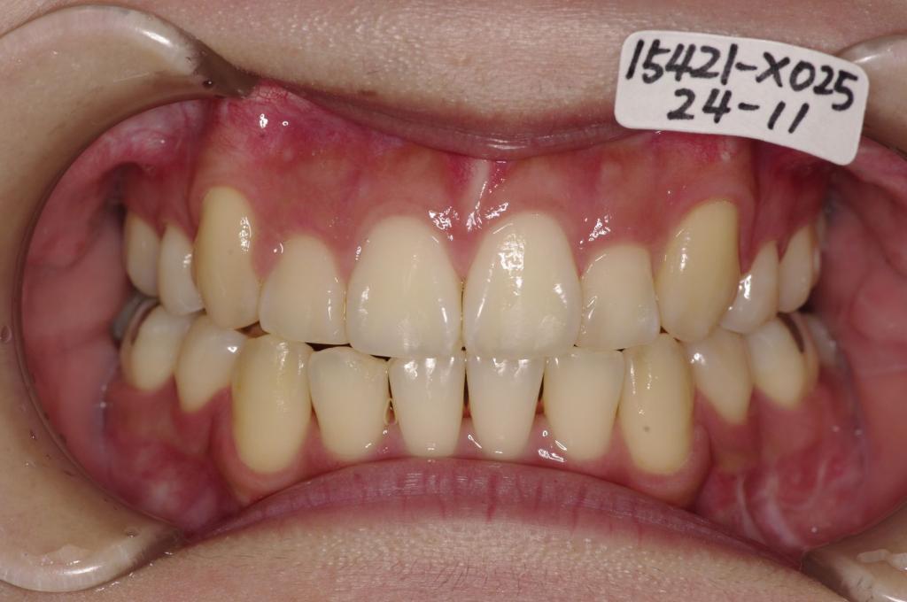 顎、顔の歪みの矯正治療後口内写真NO.502
