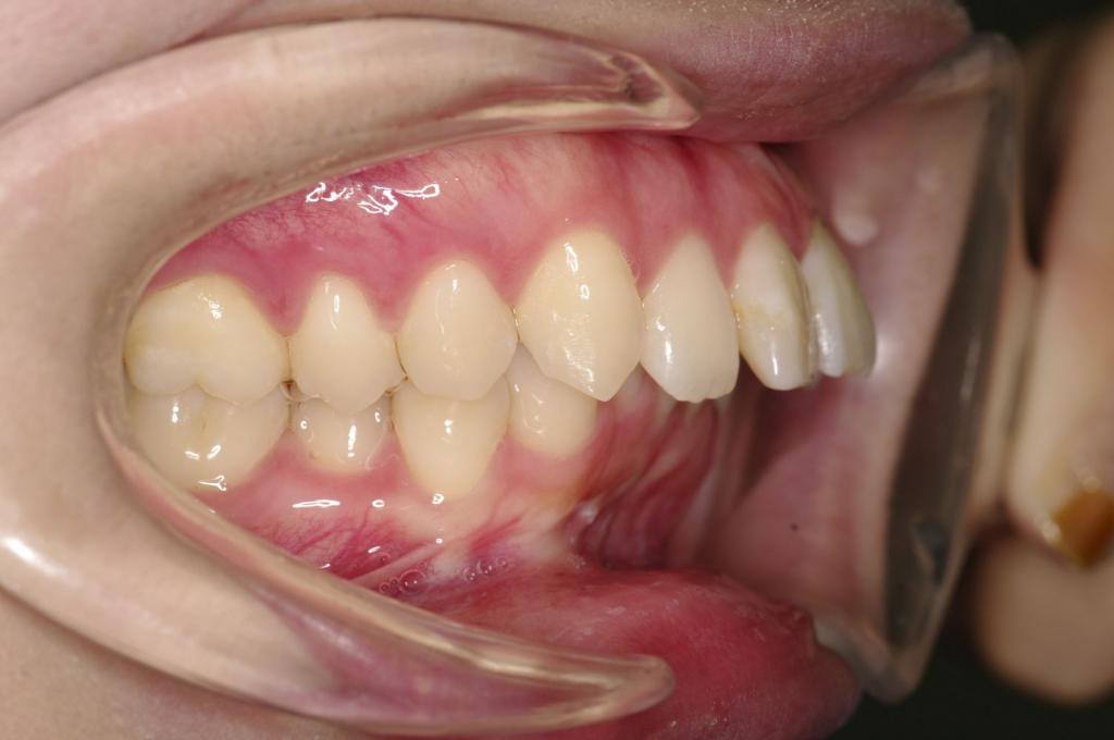 顎、顔の歪みの矯正治療前口内写真NO.503