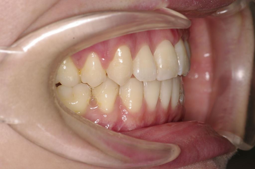 顎、顔の歪みの矯正治療後口内写真NO.503