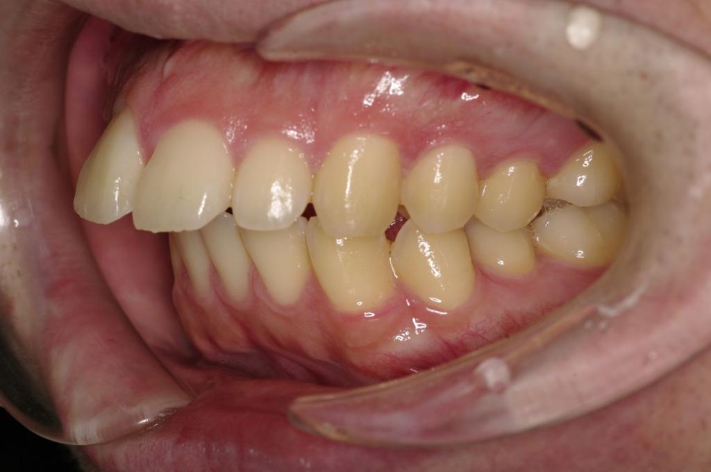顎、顔の歪みの矯正治療前口内写真NO.504