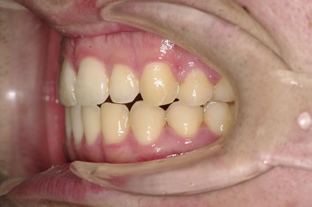 顎、顔の歪みの矯正治療後口内写真NO.504
