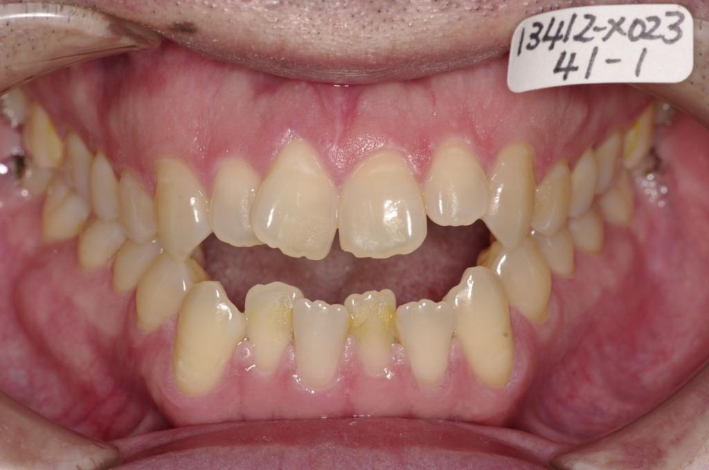 顎、顔の歪みの矯正治療前口内写真NO.505