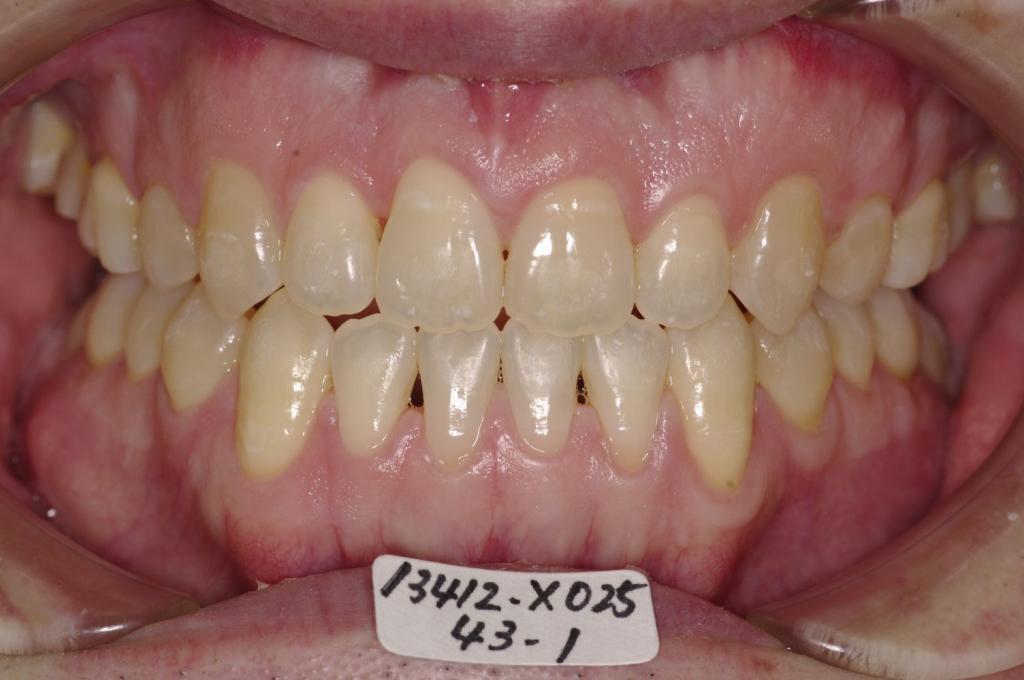顎、顔の歪みの矯正治療後口内写真NO.505