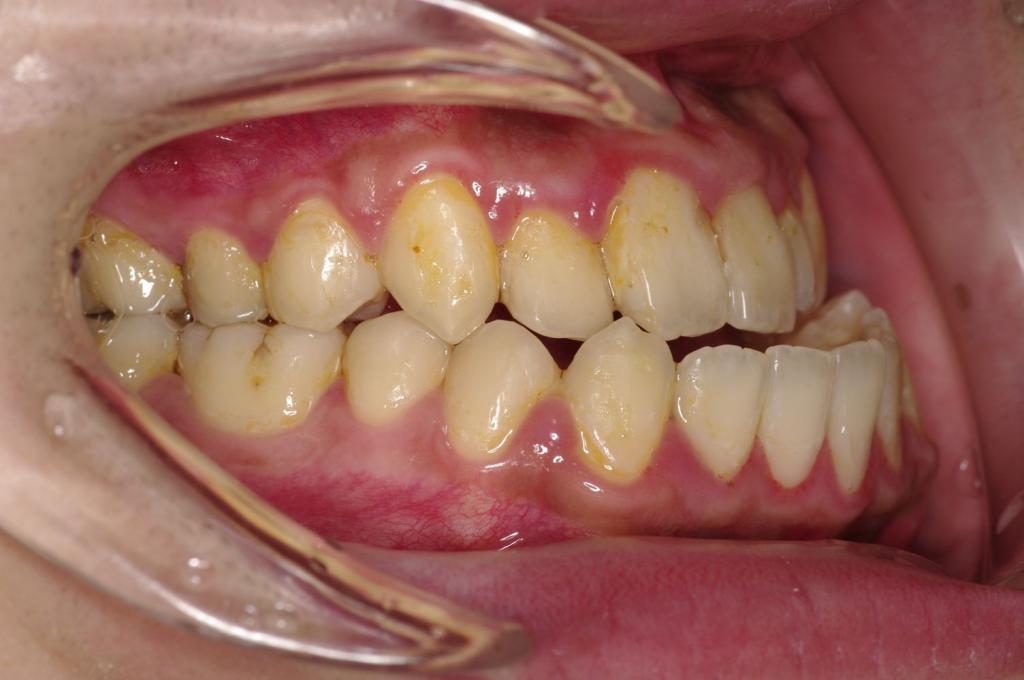 顎、顔の歪みの矯正治療前口内写真NO.506