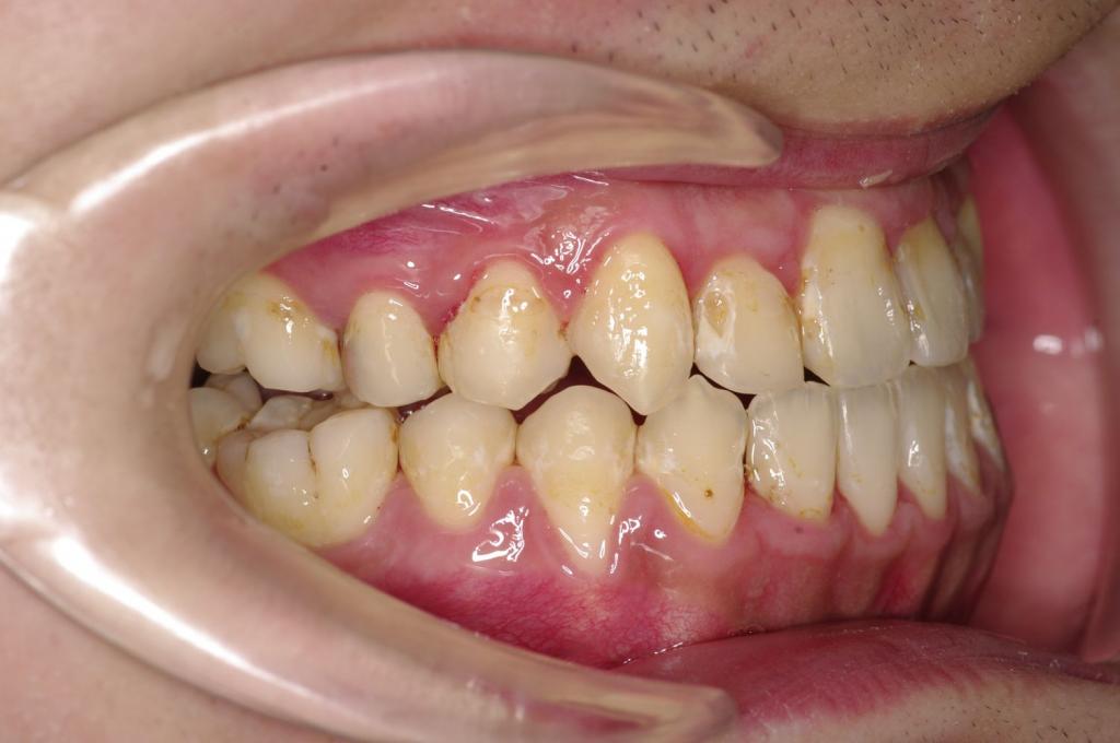 顎、顔の歪みの矯正治療後口内写真NO.506