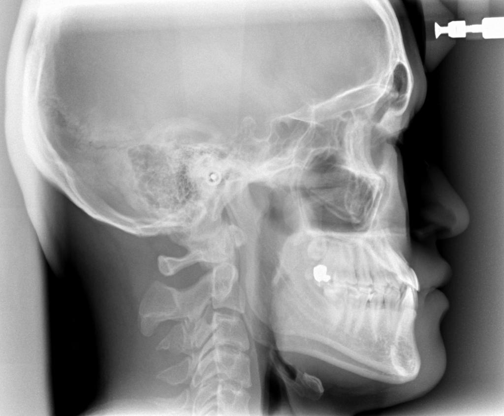 顎、顔の歪みの矯正治療前口内写真NO.507