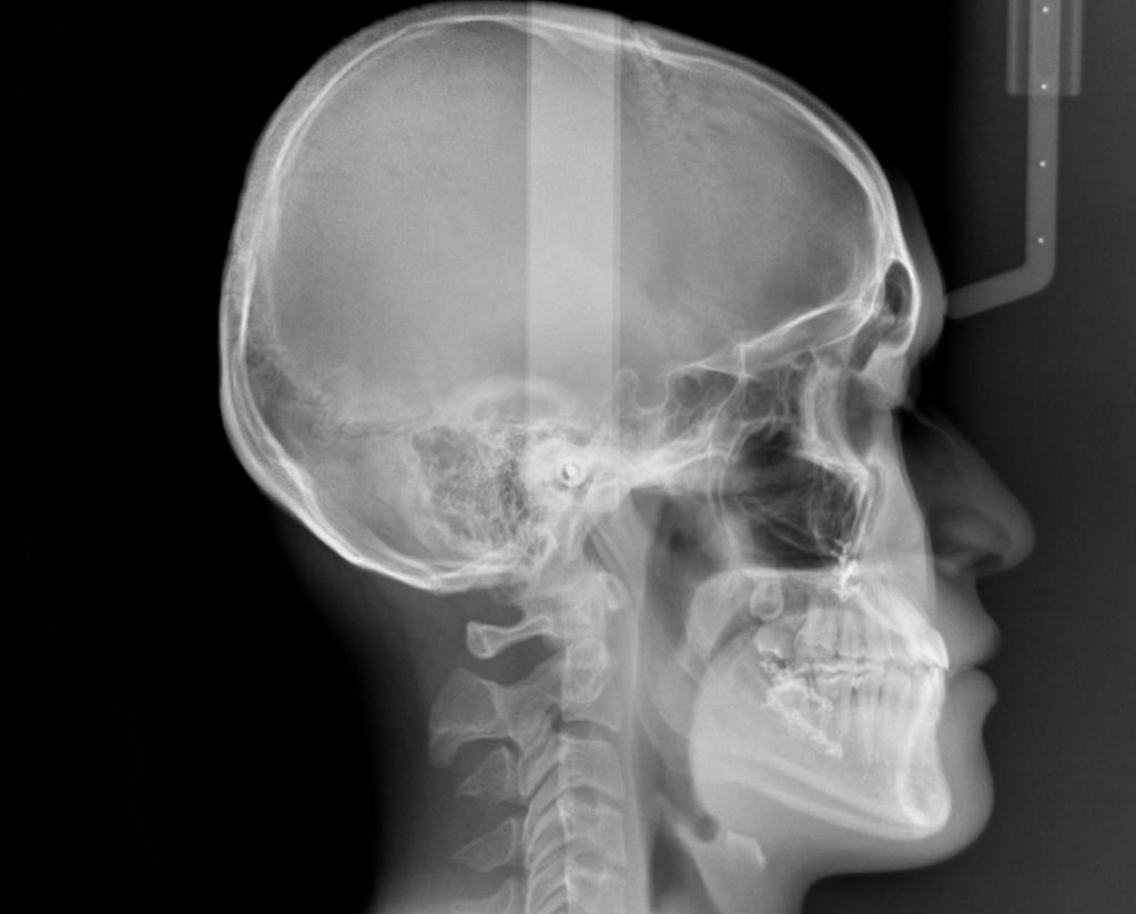 顎、顔の歪みの矯正治療後口内写真NO.507