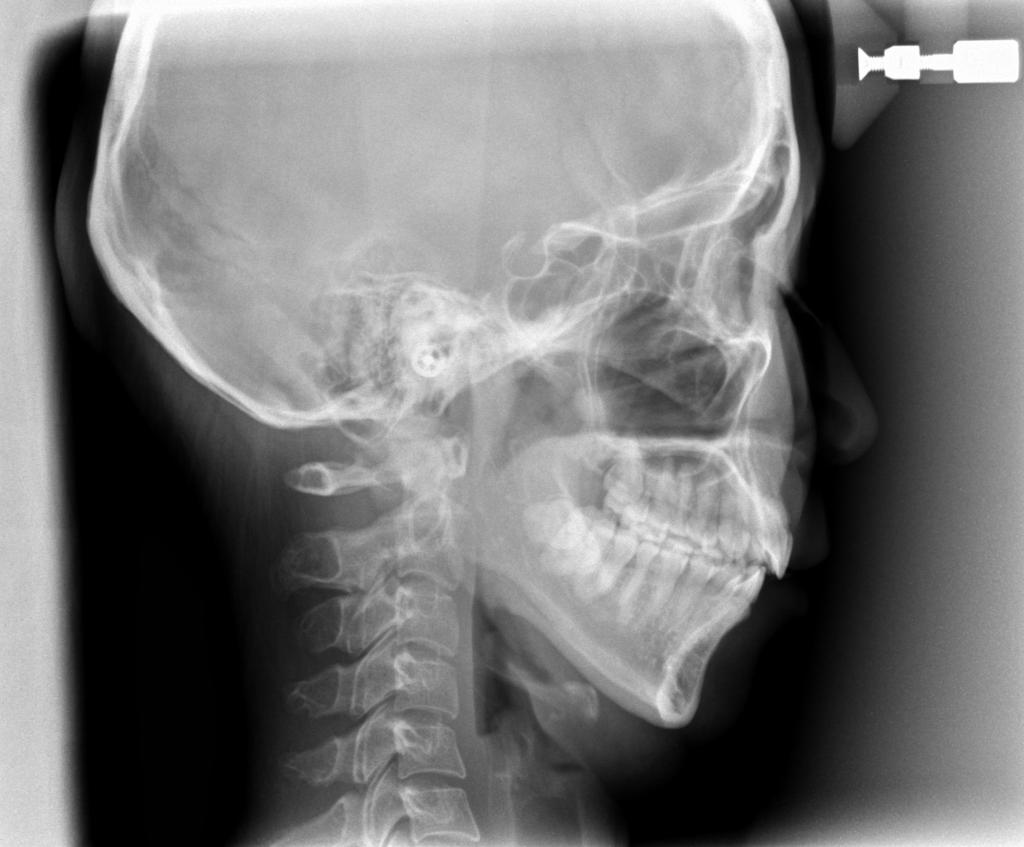 顎、顔の歪みの矯正治療前口内写真NO.508