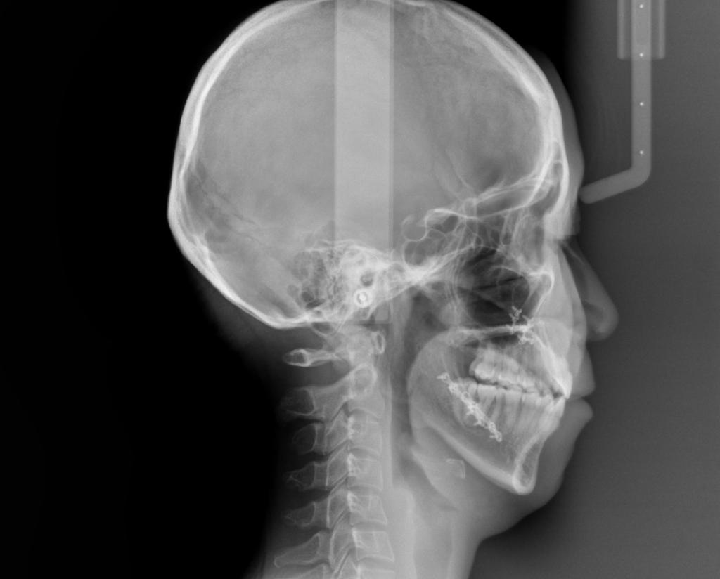 顎、顔の歪みの矯正治療後口内写真NO.508