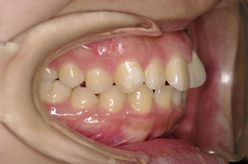 顎、顔の歪みの矯正治療前口内写真NO.509
