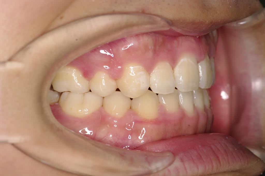 顎、顔の歪みの矯正治療後口内写真NO.509