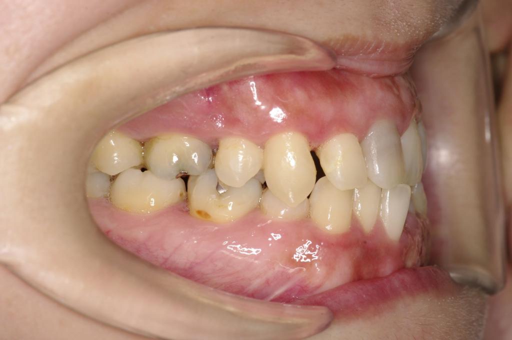 顎、顔の歪みの矯正治療前口内写真NO.510