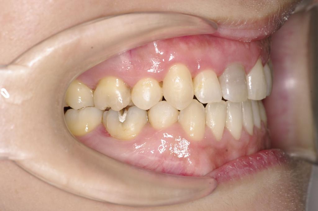 顎、顔の歪みの矯正治療後口内写真NO.510