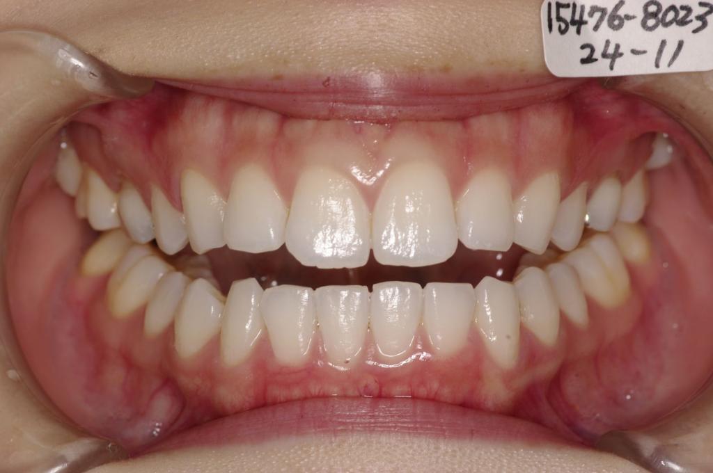 顎、顔の歪みの矯正治療前口内写真NO.513
