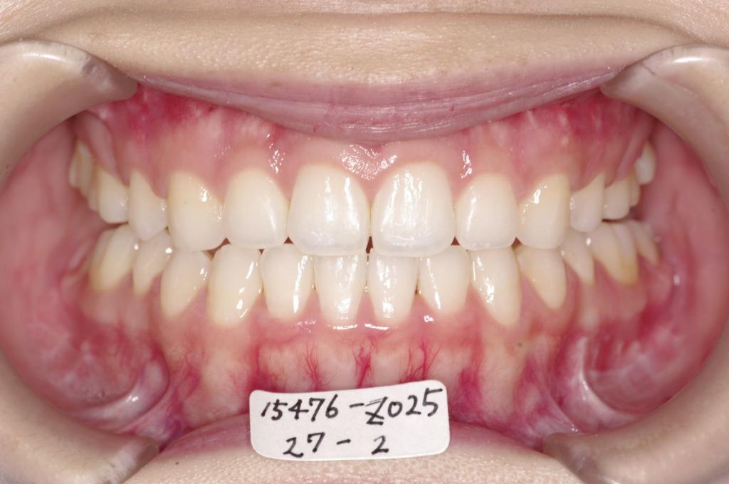 顎、顔の歪みの矯正治療後口内写真NO.513