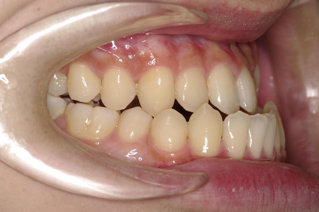顎、顔の歪みの矯正治療前口内写真NO.514