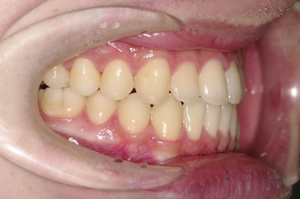 顎、顔の歪みの矯正治療後口内写真NO.514