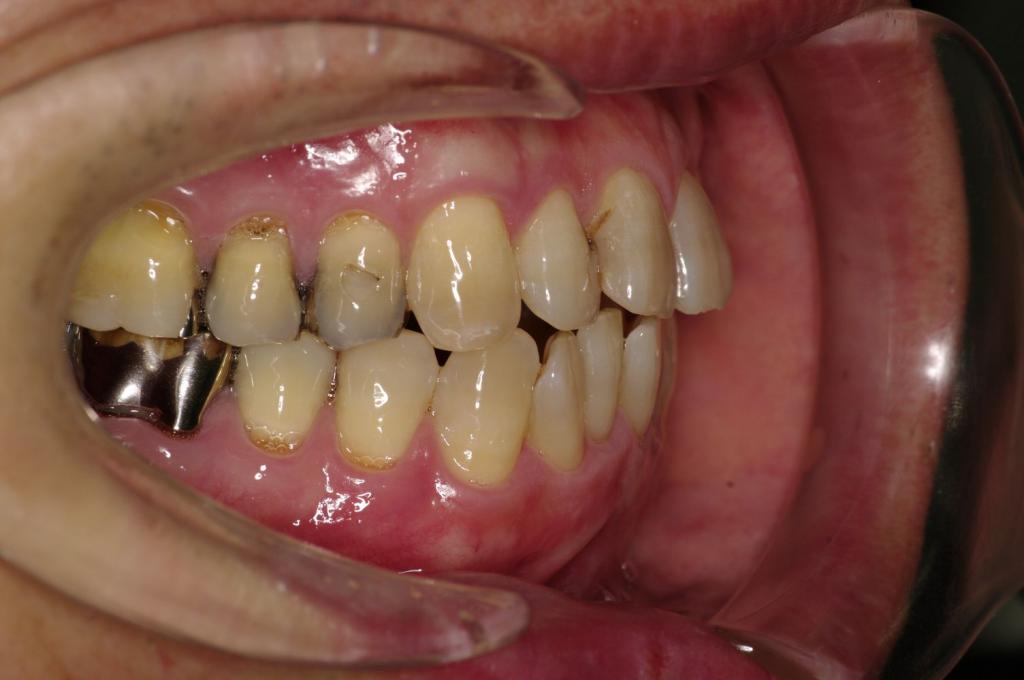 顎、顔の歪みの矯正治療前口内写真NO.515