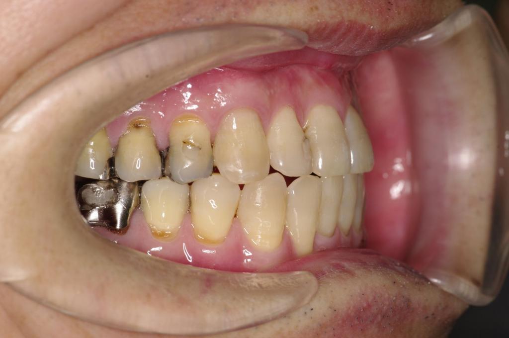 顎、顔の歪みの矯正治療後口内写真NO.515