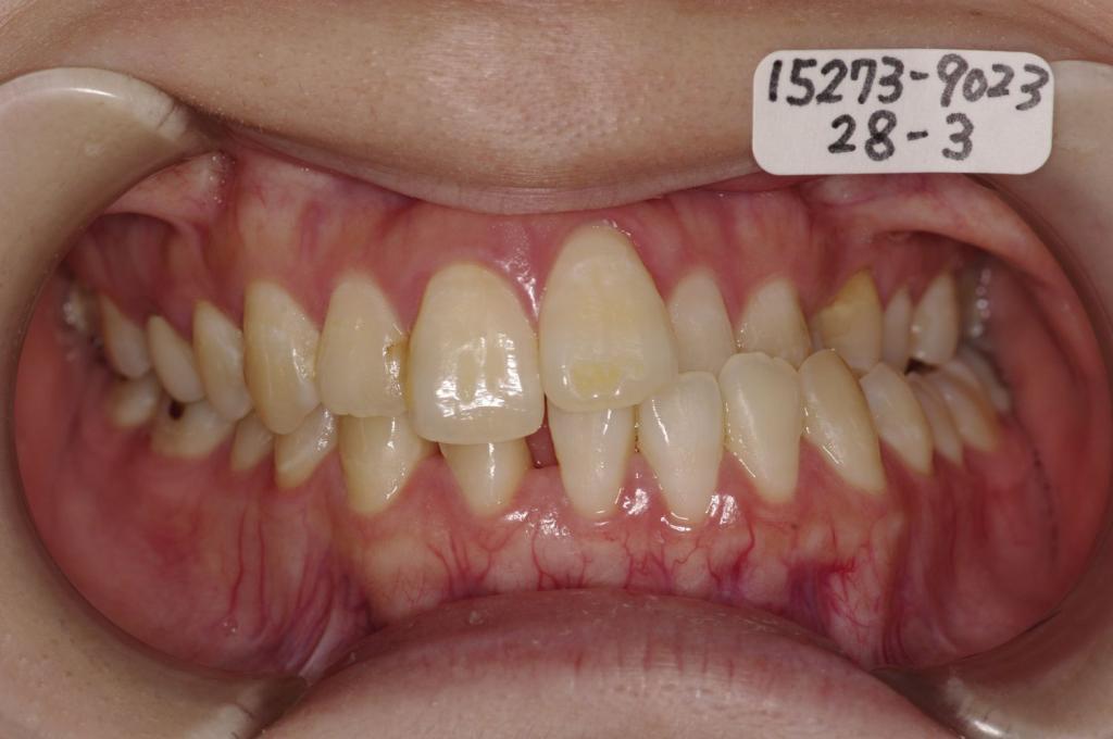 顎、顔の歪みの矯正治療前口内写真NO.516