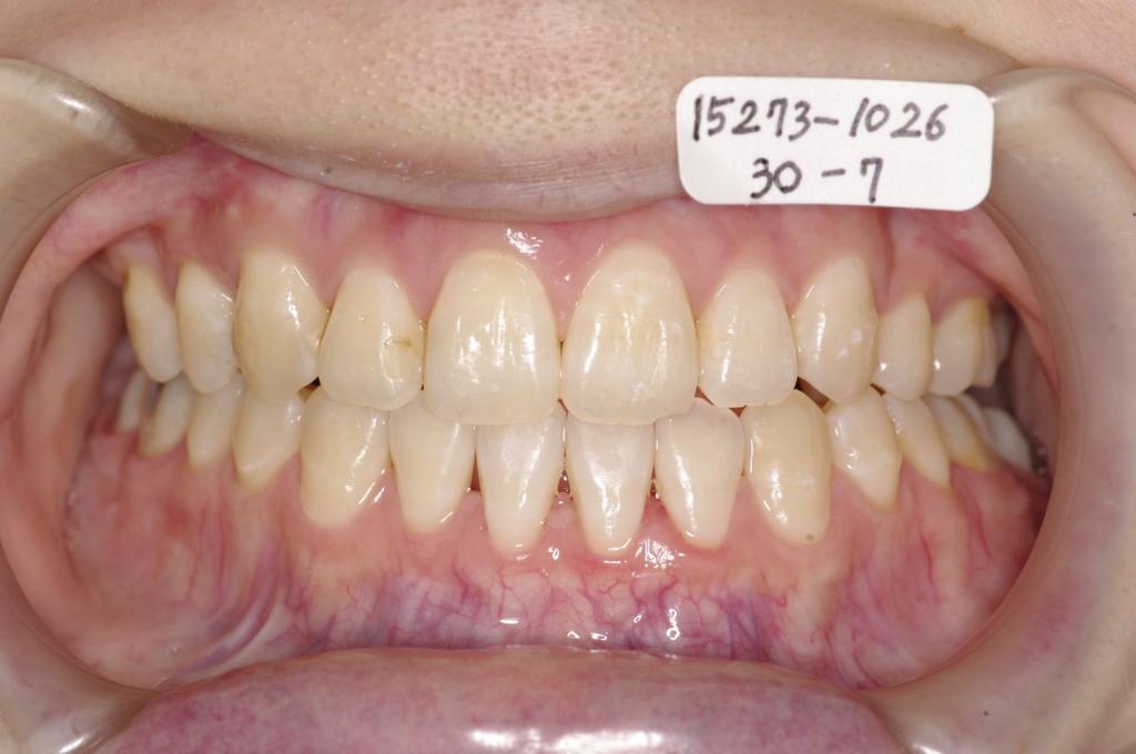 顎、顔の歪みの矯正治療後口内写真NO.516