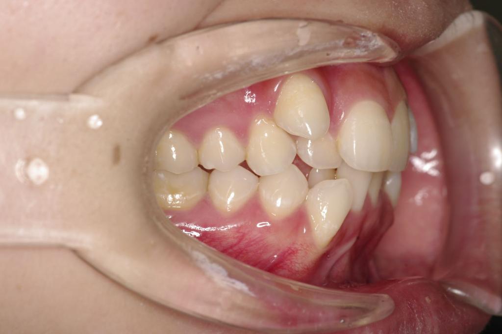 顎、顔の歪みの矯正治療前口内写真NO.517