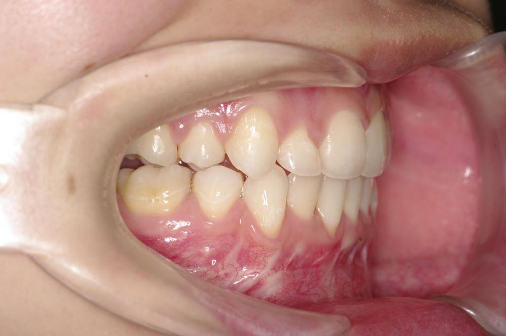 顎、顔の歪みの矯正治療後口内写真NO.517