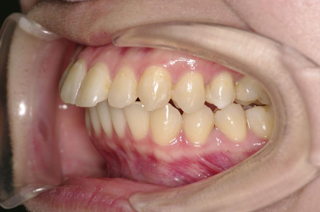 顎、顔の歪みの矯正治療前口内写真NO.518